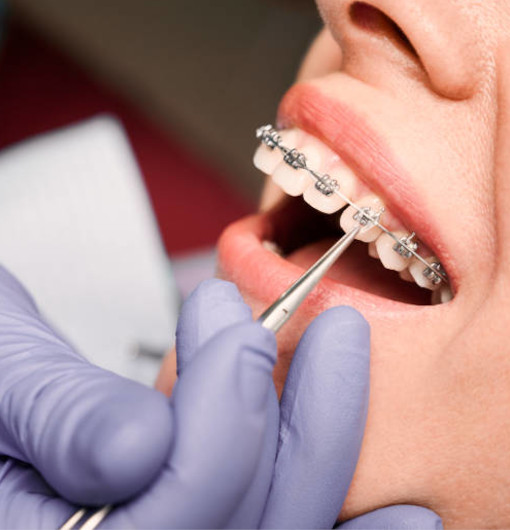 Fixed Orthodontic Treatment